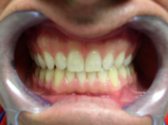 After Invisalign